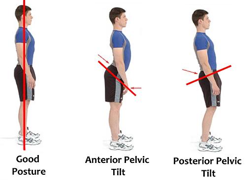 Tilted Pelvis